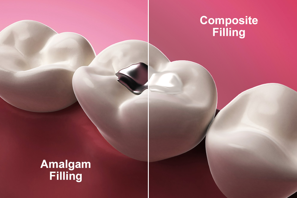 Dental-Fillings-Comparison
