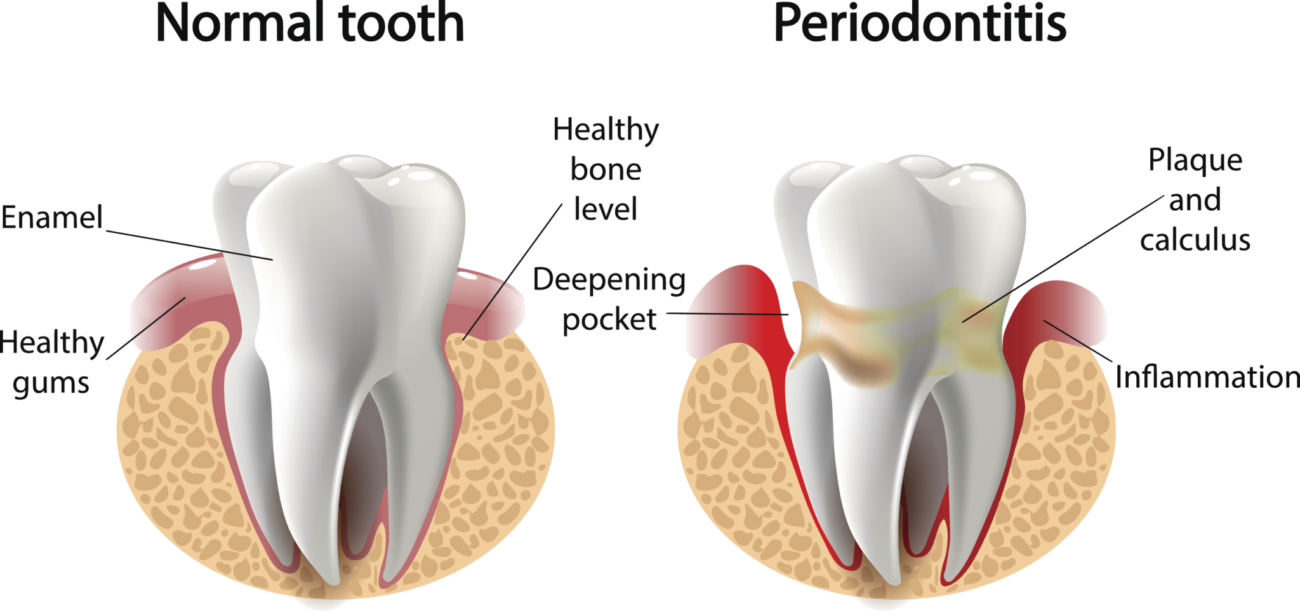 normal-vs-periodontitis
