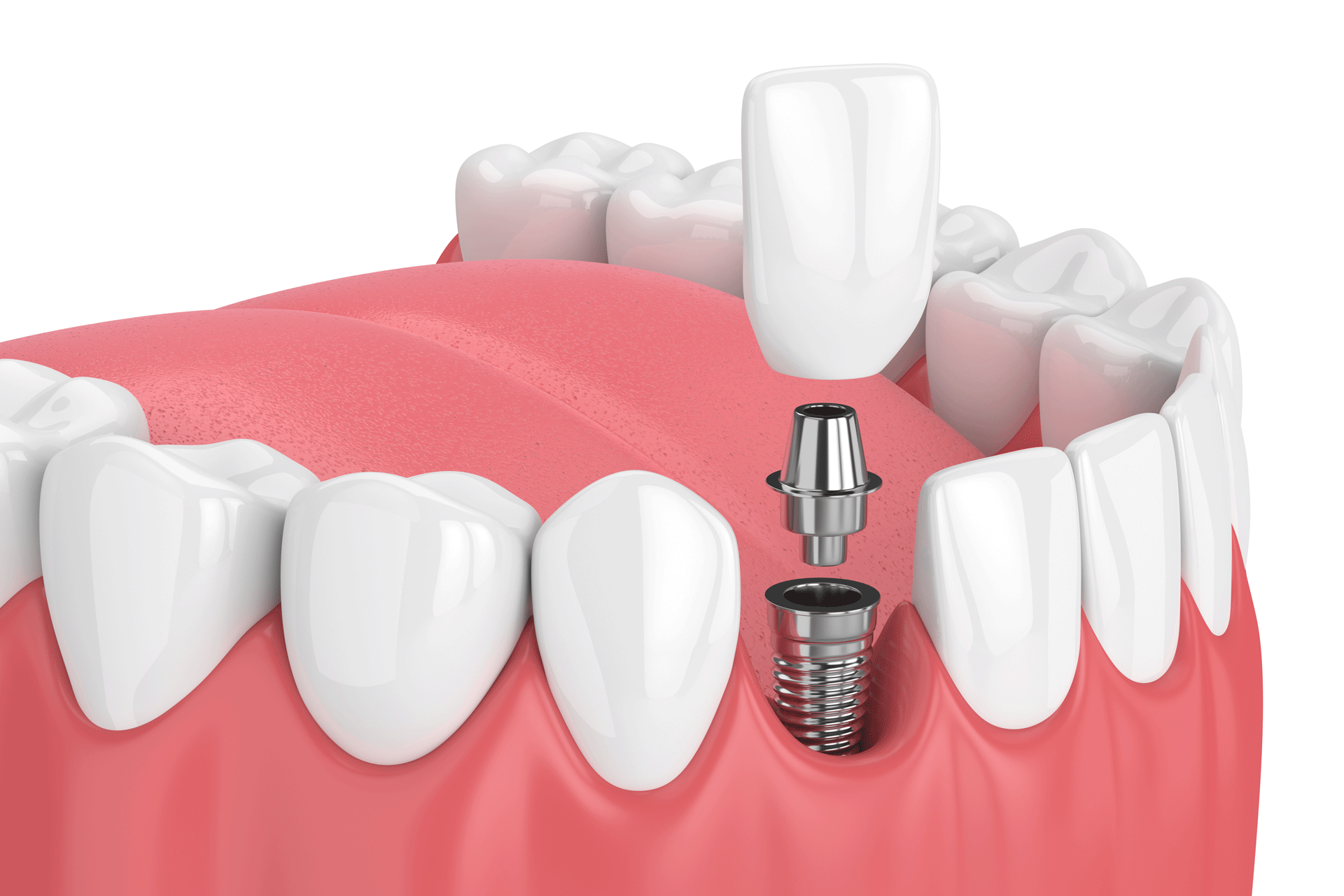 dental implant services cosmetic dentistry phoenix glendale dentsit