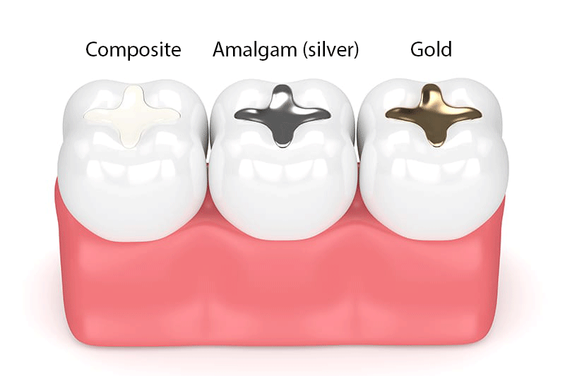 types of dental fillings services phoenix glendale arizona